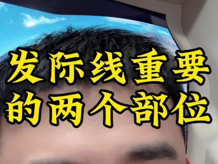 告诉所有女生发际线设计最重要的两个部位,也是很多女生最容易忽略的两个位置#拯救发际线 #内容太过真实 #植发的人后来怎样了 #植发 #发际线