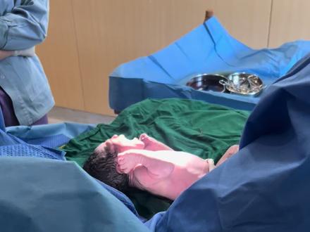 #迎接新生命 #新生宝宝 ,汇报一下情况,昨晚凌晨12点左右开了二指,立马打了无痛,针头特别长,但是淼淼特别牛,叫都没叫一声,途中一直持续宫缩,到了凌晨3-4点左右,已经开到了6指,导乐就来了,导乐得知淼淼两天才睡了4个小时,立马说你现在乘着不是特别痛就多睡一会,能睡就睡,到时候生娃有力气,但是淼淼一直睡不着,时间到了6点多了,开到了8指,还没有完全要开全指破水的迹象,由于时间太长,医生担心产妇各方安全,于是采取人工破水,随后就淼淼同感特别强烈,很快就准备要生了,这时导乐就很耐心的教淼淼一些呼吸的技巧,同时接生的医生随后就陆续到场了,每个医生都很耐心,语气很好,不停的教淼淼技巧,医生在告知做好马上开始的准备时,淼淼突然上半身剧烈发抖,原因是生大宝的时候6斤不到,宫颈管重度严重撕裂,所以留下阴影,这个时候医生都在给她加油打气,并鼓励她要好好配合,说你现在所具备的条件这么好,一定不会有问题的,然后淼淼才慢慢的不那么害怕,但还是时不时的发抖,马上医生就问有没有拉屎的感觉,如果有的话我们就开始,随后机器宫缩的波浪曲线持续上升,并且淼淼说现在宫缩来了,随后立马第一次持续憋气用力,医生开始接生了,很很很顺利,总共用时30-40分钟左右,宝宝顺利出生了,淼淼哭了,轻微裂伤,顺顺利利,感谢所有医护人员!!感谢感谢!