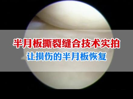 半月板撕裂缝合术是什么样的?实拍半月板手术膝盖场景#半月板撕裂手术 #膝盖积液 #膝盖疼痛腰部不适