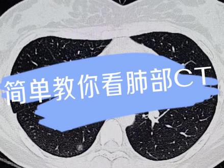 可以简单了解一下肺的CT怎么看!