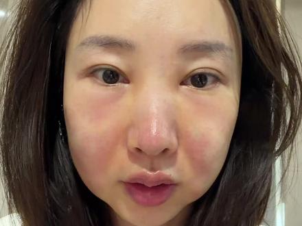 蓉芷后的一周 肿到没朋友#蓉芷 #脂肪填充 #馒化修复 #医美 #溶脂