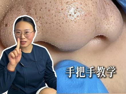 手把手教学,居家版去黑头教程! #黑头 #草莓鼻 #油痘肌 #护肤