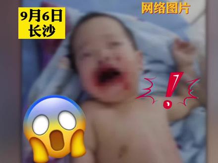 #男童误食管道疏通剂致口腔灼伤 宝爸宝妈们请注意,危险物品一定要远离儿童