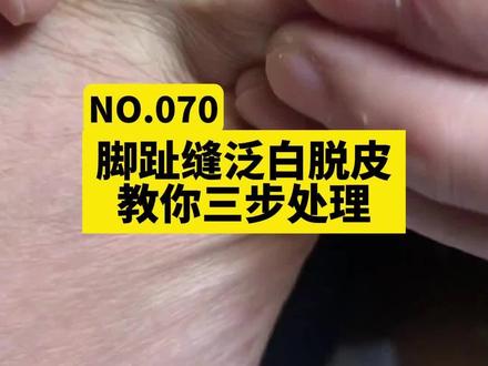 脚趾缝泛白脱皮,痒到脚趾来回蹭,教你三步处理#dou来说健康 #脚气 #脚气用什么药 #糜烂型脚气 #脚趾头中间脱皮烂了痒怎么回事