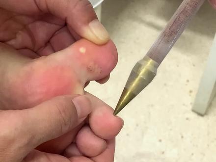寻常疣增生液氮冷冻治疗!#皮肤病 #寻常疣 #液氮冷冻