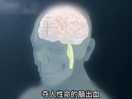 脑出血的常见病因#3D演示 #脑肿瘤 #医学知识科普 #健康守护计划