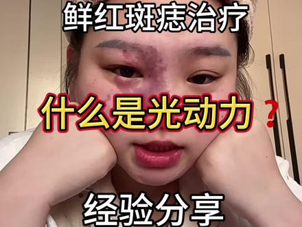 #鲜红斑痣 三次光动力经验分享 希望能帮到有需要的姊妹们♥️