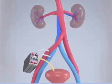 #人工肾#科普#透析 希望这一天,能早日到来。