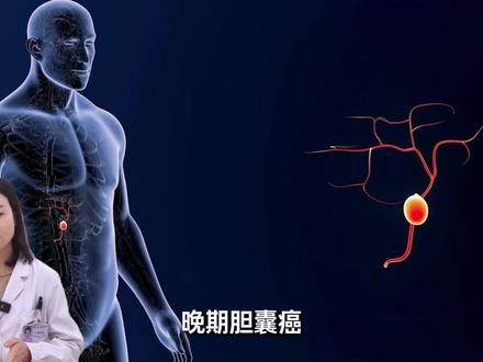 胆囊癌的高危人群和高危因素#胆囊癌 #抖出健康知识宝藏 #全民健康素养提升 #癌症