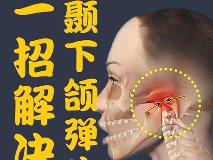 你是不是也有过嘴巴张大时挂钩弹响、疼痛呢? #颞下颌关节紊乱 #下颌骨弹响 #弹响