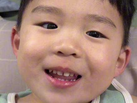 修补我的大门牙 #大门牙 #小孩哥