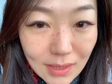 41岁老阿姨皮秒淡斑后修复分享,无美颜无滤镜真实状态。今天,是未来日子里最年轻的一天,善待自己吧!#淡斑