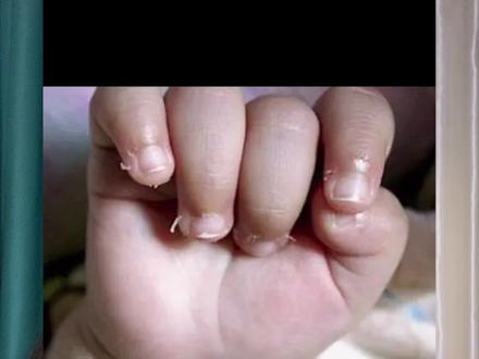 宝宝手上长倒刺怎么办?是缺锌吗?缺维生素吗?千万不要去拔,很容易引起感染。可以用可入嘴的婴儿护唇膏进行保持效果明显#婴儿唇膏