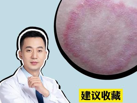 大腿内侧长红斑,特别痒,可以这样简单处理#股癣#皮肤#科普 #特比萘芬喷雾