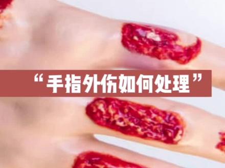 手指外伤的紧急处理#守护健康 #健康科普 #健康 #医学科普 #把健康带回家