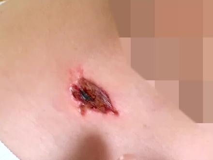 祛痣膏其实就是坑!#健康科普 #南方健康 #涨知识