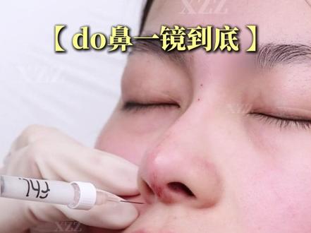 【实录】一💉爆改扁塌鼻、即刻立体 #塌鼻子 #蒜头鼻 #妈生鼻 #好看的鼻子 #注射隆鼻