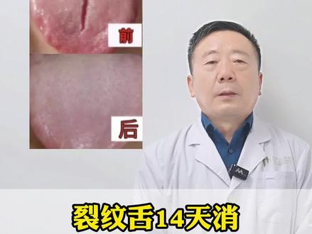 裂纹舌14天消,靠得不是香砂六君子,而是这两招 #舌诊