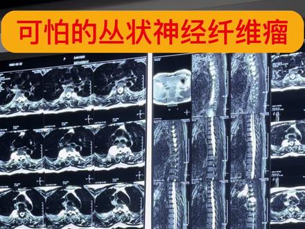 神经纤维瘤病靶向药临床招募中 #神经纤维瘤病