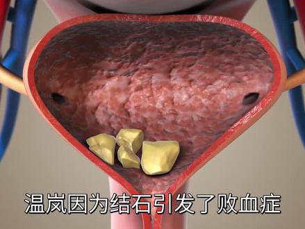 知名女歌手在ICU抢救10天,终于脱离危险!病因公布↗️#娱乐圈#明星#歌手#温岚