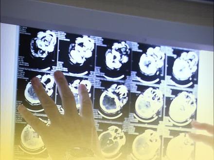 在脑外伤 患者中, 会有一部分人精神不正常,其实和额叶损伤有很大的关系。#脑外伤 #精神不正常 #额叶损伤 #硬核健康科普行动 #周范民