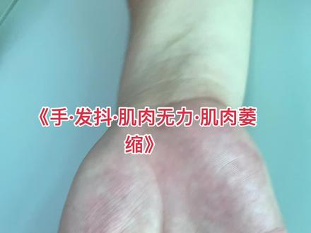 青少年常见的肢体远端进行性肌肉萎缩与无力 原因不是很清楚 考虑平山病的可能性大#青少年#肢体萎缩#肌肉萎缩#平山病#抖音小助手 #抖音#医学科普#医学知识#dou#dou+#健康#健康最重要