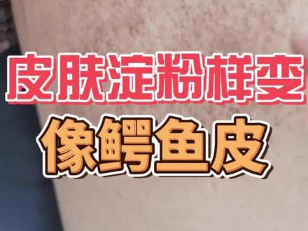 #皮肤淀粉样变 如果不及时就医,会越来越严重,影响正常生活 #瘙痒 #dou来说健康 #国广健康 #通用技术集团