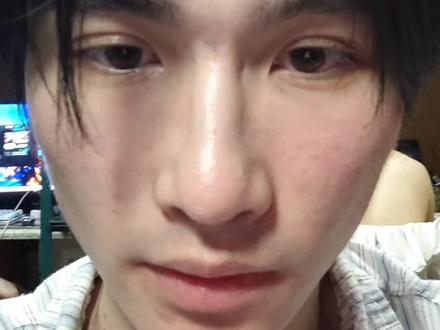 三个月前我开始针对面颊位置的痘印色沉,使用一些产品与护肤品。
最开始是用的是喜辽妥的乳膏大白开的,可以退红淡化红痘印,涂了大概有20天,泛红退了不少,但是对我脸上的陈年痘印的淡化就不对口了。
所以我又买来了可以美白淡斑的产品,有维C精华和烟酰胺精华,还有加速角质代谢的维A酸,刚开始我的用法是早上涂维C,晚上间隔使用烟酰胺精华和维A酸,但是发现刺激太大了,皮肤屏障会受不了,而且白天使用维C也不是一个好的选择,于是我开始只用维C,也是为了测测这个产品是不是有用,然后我就坚持用了快两个月,晚上睡前涂,频率大概两天一次,最后一看效果,痘印色沉几乎没有变化,这就已经到六月份了。
然后我前段时间就打算换烟酰胺精华试试,但是浓度太高了有10%,涂了皮肤屏障也受不了,皮肤非常紧绷还起皮,也是涂涂停停,最近我又购入了传明酸也是美白的,涂了两三天了。
这就是我这两三个月来的针对痘印色沉的护肤,反思一下,首先频繁更换产品肯定是不对的,容易导致皮肤敏感,而根据我的理解和了解,淡化黑痘印和色沉,主要需要三步“剥脱-美白-代谢”,而这段时间来我几乎只用了美白的产品,没有用酸去对废旧角质进行剥脱,然后促进角质的代谢,所以既然意识到了,后续我也会进行针对性的调整。
现在的皮肤确实比较敏感,用了点刺激性的成分就泛红发热,所以最好还是先维稳,涂舒缓的精华和乳液,再加上比较不刺激的传明酸来美白,然后先对维A酸进行耐受的建立,去促进角质的代谢。
给自己加油👊👊