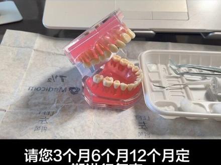 窝沟封闭技能流程操作
适应症:深窝沟、萌出完好无龋坏、龋易感儿童优先做。
禁忌症:窝沟浅自洁好、已有龋洞、牙齿未完全萌出、树脂过敏不建议做。
最佳年龄:3~4岁乳磨牙、6~8岁六龄齿、11~13岁第二恒磨牙。
标准六步流程:清洁牙面→严格隔湿→37%磷酸酸蚀(恒牙20-30s/乳牙60s)→冲洗吹干呈白垩色→涂布封闭剂无气泡→光固化20-40s+调颌检查。
核心要点:严防唾液污染、酸蚀后禁触碰、定期3、6、12个月复查,不替代刷牙和涂氟!#窝沟封闭 #口腔技能考核 #口腔医学生#口腔技能实践操作考试