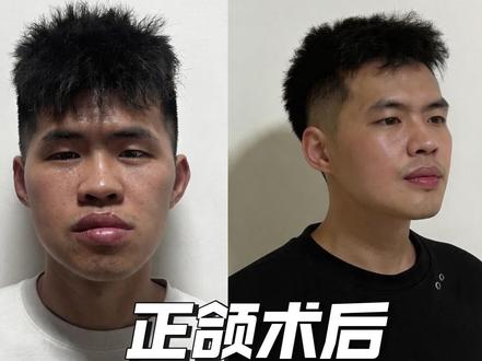 #真实生活分享计划 正颌术后一个月,遇到了什么问题?带来了什么变化?#正颌 #正颌手术记录 #正颌手术