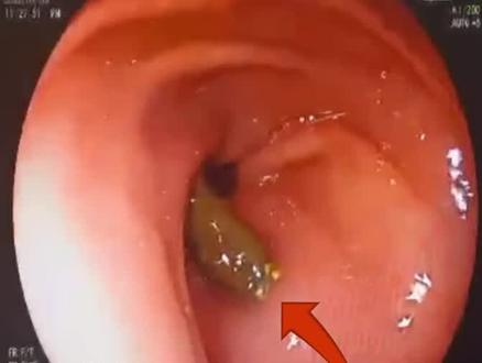 囫囵吞枣并不少见,不小心吞了枣核,怎么办?#科普一下 #误食异物