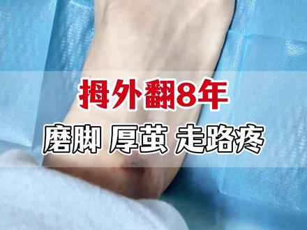 拇外翻8年,磨脚 厚茧 走路疼 #拇外翻 #大脚骨 #拇外翻微创 #顾锋第四代超微创