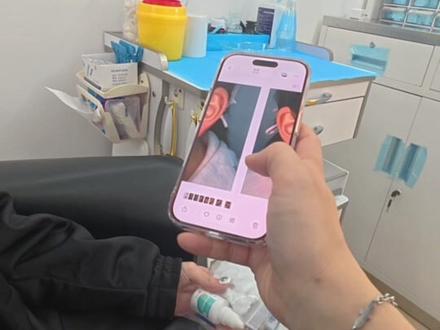 特别喜欢这种圆溜溜的耳垂,打完耳垂,极致对称简直就是强迫症的福音
#穿孔师kk #中山艺耳美 #中山手穿 #打耳洞过程