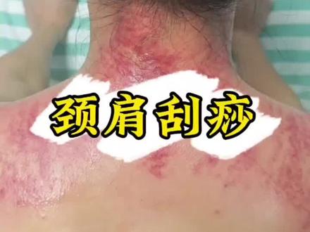 妇一科中医特色技术之颈肩刮痧#刮痧#中医特色技术