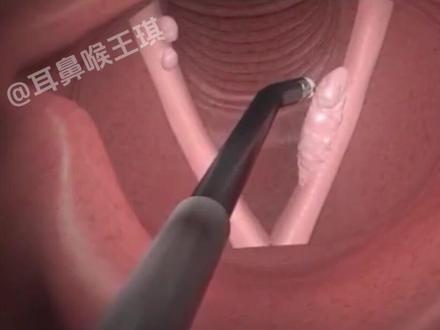 3D动画演示,#声带息肉 切除术!#耳鼻喉王琪