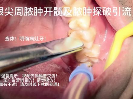 #口腔健康 #口腔科普 #上热门🔥 #涨粉 #脓肿 限流了😭重新打码发一下:分享一个根尖周脓肿的病例🌹🌹
