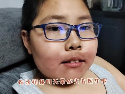 孩子嘴又裂了,这啥呀?冻疮么?为啥只冻嘴?要不要看医生? #冻疮