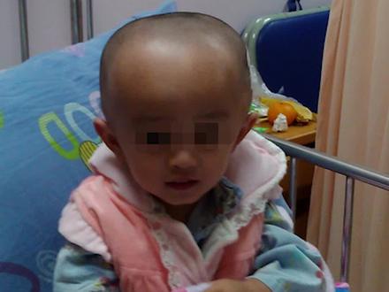 新生儿脑积水能治愈吗?#健康 #关爱儿童健康 #脑脊液 #脑积水