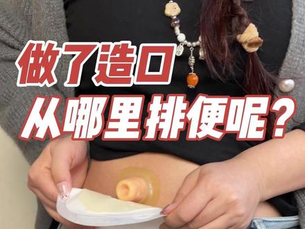 做了造口从哪里排便呢?#造口袋 #造口袋清洗 #造口人生活 #造瘘 #一件式造口袋