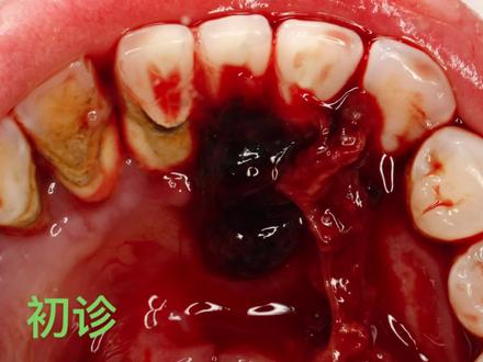 #牙龈出血#洗牙好么 在很多医院觉得这个牙龈出血问题很棘手,来到我们医院能够轻松解决。主要是由于全国牙周医生的匮乏,对于牙周炎的处理没有专业的知识。如果你牙龈出血,来我们口腔科找牙周医生就对了。