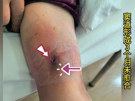 #上臂置管后 #窦道形成