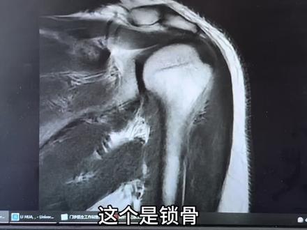 肩关节MRI解剖讲解(斜冠状位) #肩关节MRI解剖讲解#干货分享#肩关节核磁 #肩关节MRI#科普知识