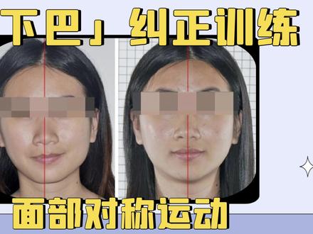 一个动作纠正【歪下巴】,改善“假性”面部不对称。重塑上镜对称脸!#变美 #笑容 #大小脸 #美容 #面部不对称 #大小脸 #歪脸女孩
95%歪下巴都是“假性”的!首先下巴具备向一侧歪的运动模式,当长时间下巴歪向一侧,说明这一侧“咬肌”和“颞肌”一直处于紧张或者发力的状态,但是下巴不能回归到正常位置,从而导致面部外观发生歪脸或者下巴歪的特点。
纠正频率:每天4到6组,每组1分钟。至少练习7天开始变美。
建议收藏转发,️祝宝宝们越来越美!