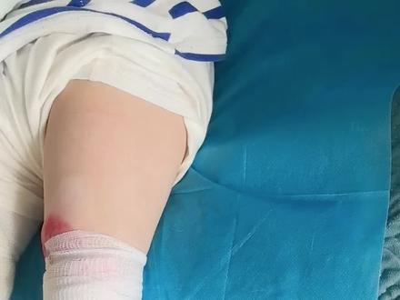 护理蝴蝶宝贝的一天
关于很多很多粉丝问的产检问题
我在此说明一下
生她之前 孕期产检一路绿灯
就是为了筛查传染病
自费了2980做了无创puls
是筛查108种染色体
结果也是全都阴性正常的
然后生下来后 才被告知是蝴蝶宝贝…
这个罕见病 普通产检查不出来
羊水穿刺也查不出来…
需要做全外显基因比对才能排查出来
因为我和孩子爸爸
以及两边的家族 祖上很多很多代
皮肤都是正常人
从来没有过这种一碰就破的情况
在生她之前
我们也从来没听说过这种病
所以压根也没想到要做基因比对
那时候在我的概念里
以染色体就能排查很多疾病了…
她在宜昌市第一人民医院出生
出生后 整个医院也都很震惊
说是市里首例病患…
总之就是这样一个情况。
我想对已经怀孕的妈妈们说
也不用过渡焦虑
正常情况下产检一路绿灯
宝宝也都会是健康的
我们家这个情况属实是意外
运气不好 40万分之一的概念
这个真的堪比福利彩票中奖的概率…
所以待产的妈妈们 别焦虑
该吃吃 该睡睡
该产检产检 少熬夜 就行了。
你们一定会❤️
顺利生下健康聪明的乖宝宝🙏
我们会加油 每天给她极致护理
至于未来走到哪一步 未来再说。
车到山前必有路 船到桥头自然直。
#罕见病 #蝴蝶宝贝 #罕见病孩子的努力成长 #罕见病宝宝的故事 #罕见病孩子的努力