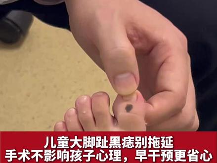 儿童大脚趾黑痣别拖延,手术不影响孩子心理,早干预更省心 #色素痣