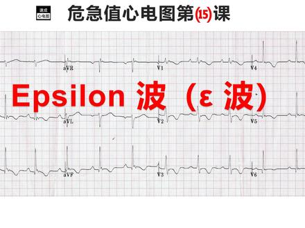 Epsilon 波(ε 波) #热点 #心电图 #直播
