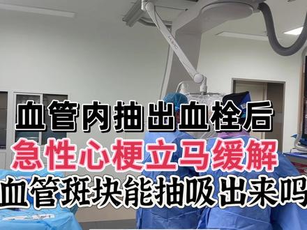 冠脉血管内抽出血栓后心梗很快缓解,血管斑块能抽出来吗? #急性心肌梗死急救 #急性心肌梗死支架置入技术