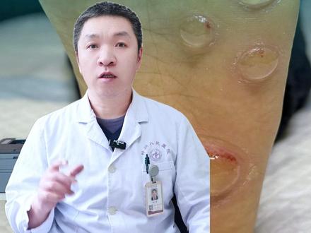 糖友注意!脚上起水疱 千万不能挤! #糖友足部水疱处理 #糖尿病足 #糖友护脚 #糖尿病并发症 #糖尿病足防护