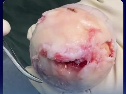 外科医生分享长期酗酒患者的股骨头 #酗酒 #股骨头坏死 #谈谈新知 #半月谈