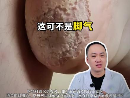 脚底板发白发臭,可不一定是脚气,别乱治! #医学科普 #脚气 #窝状角质松解症 #抖出健康知识宝藏
